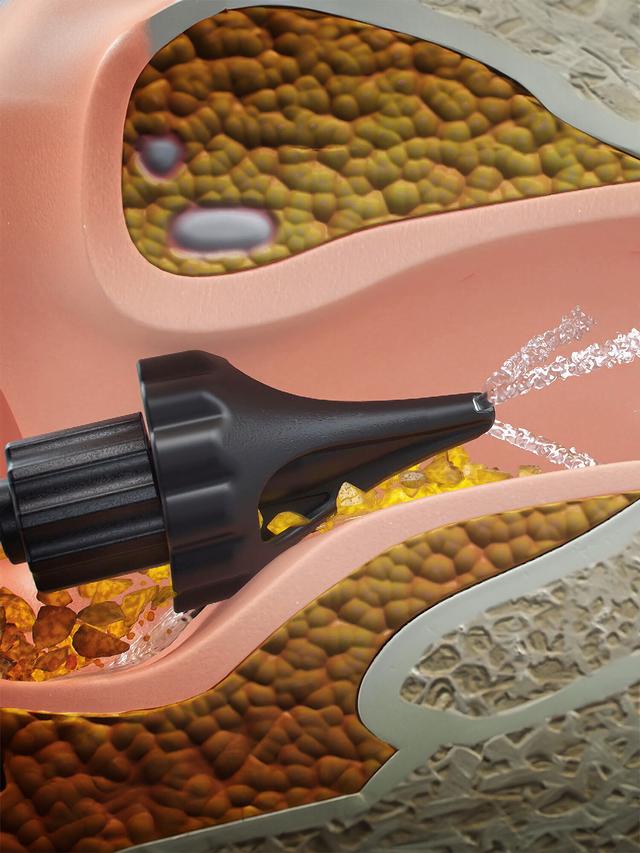 Produktbild von Ohrenreiniger Ersatzspitzen "Wush" Zubehör, 6er-Set