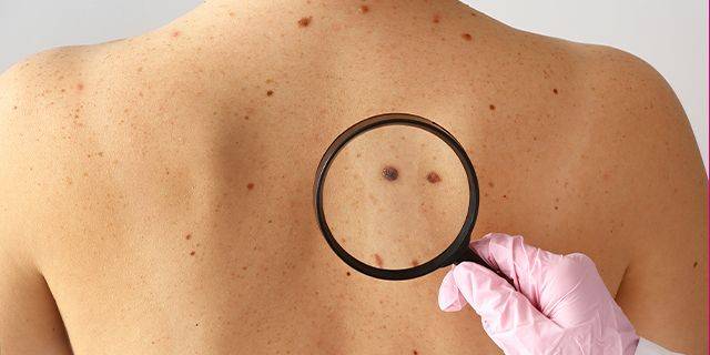 Hautkrebsuntersuchung Rücken einer Person mit mehreren Muttermalen, eines wird mit Lupe vergrößert